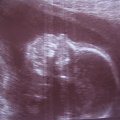 Wiktor -drugie badanie prenatalne