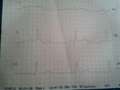 ekg